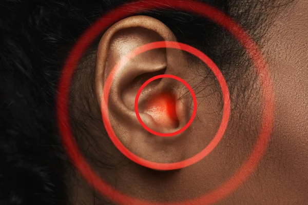 Zbliżenie Ucha Czarnej Kobiety Czerwonym Źródłem Bólu — Zdjęcie stockowe