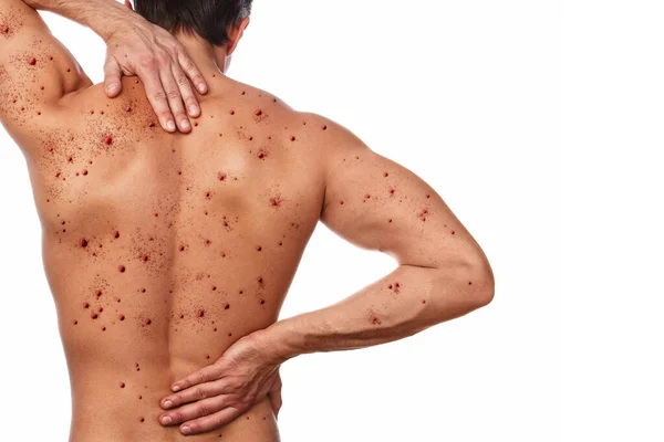 Male Back Affected Blistering Rash Because Monkeypox Other Viral Infection — Stock Photo, Image