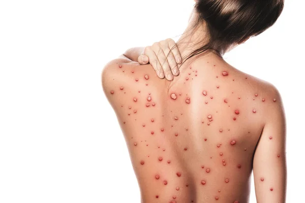 Weiblicher Rücken Von Blasenbildung Aufgrund Von Affenpocken Oder Anderen Virusinfektionen — Stockfoto