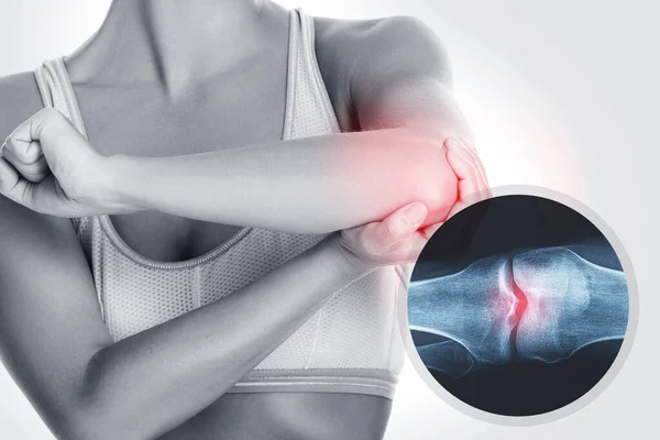 Kvinnlig Armbåge Och Röntgeneffekt Med Skadad Led — Stockfoto