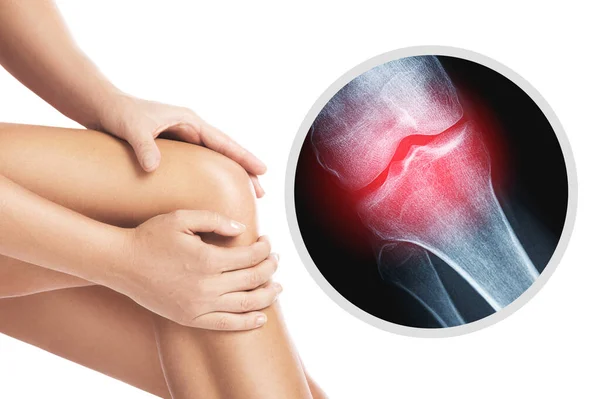 Weiblicher Knie Und Röntgeneffekt Mit Verletztem Gelenk — Stockfoto