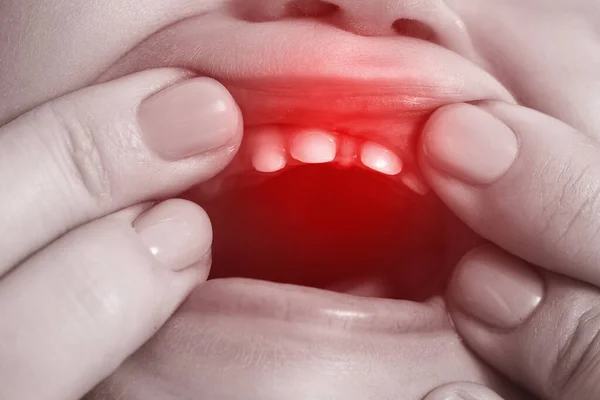 Menino Sofrendo Sintomas Dolorosos Dentição — Fotografia de Stock
