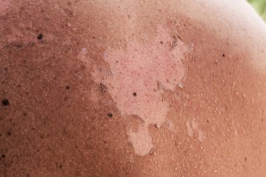 Güneş yanığı yüzünden kabuğu soyulmuş bir erkeğin yakın çekimi..