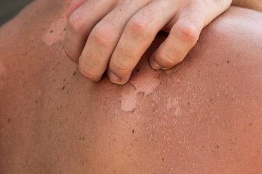 Güneş yanığı yüzünden kabuğu soyulmuş bir erkeğin yakın çekimi..