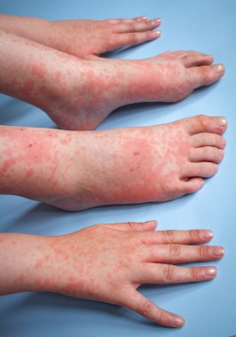 Ayaklarında kırmızı alerjik kızarıklık ve antibiyotik kullanan bir gencin cildinde de var. Kısa süreli iltihap, kızarıklık, kuru, kaşındırıcı ve ciltte tahriş..