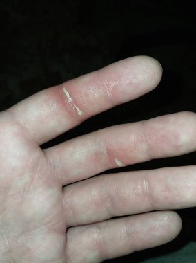 Cut fingers and smeared with the medical glue