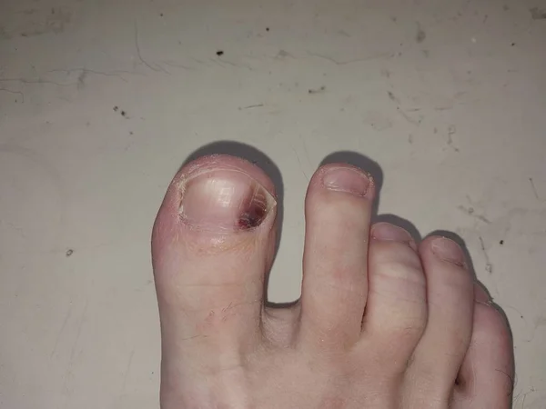 Homem Ferido Lesão Dedo — Fotografia de Stock