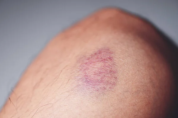 bruised on knee - wound bruised on  leg caused by sports and bump or fall, leg injury