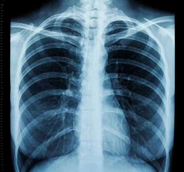 Fluorography Human Chest Frontal Ray — Stock Photo, Image