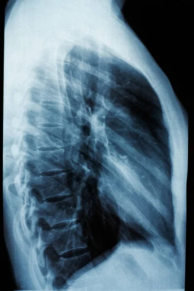 Diagnoza Prześwietleniem Fluorografia Klatki Piersiowej Widok Boku — Zdjęcie stockowe