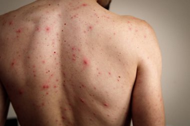 A rash of red dots and blisters on a mans back. Chickenpox is much more severe in adults. clipart