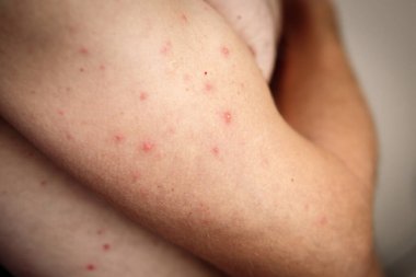 The first rash on the body of an adult man after contracting chickenpox. clipart