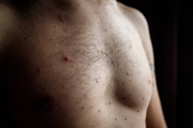 Man chest front who having varicella blisters or chicken pox or monkey pox. clipart