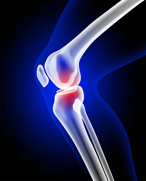 Röntgenbild Von Bein Und Knieknochen Die Schmerzen Zeigen Medizinische Nutzung — Stockvektor