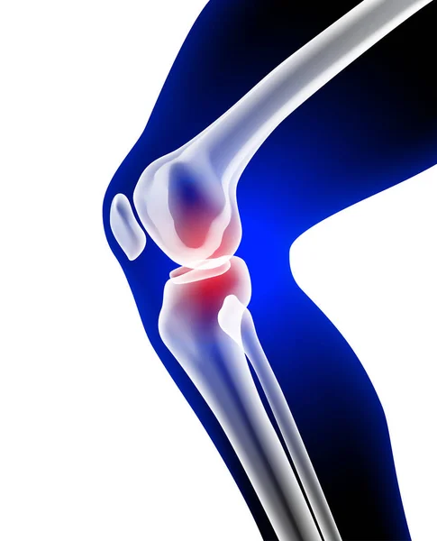 Röntgenbild Von Bein Und Knieknochen Die Schmerzen Zeigen — Stockvektor