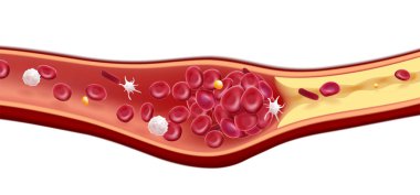 Alyuvar ve kolesterol pıhtısının 3 boyutlu çizimi ölüme neden olur..