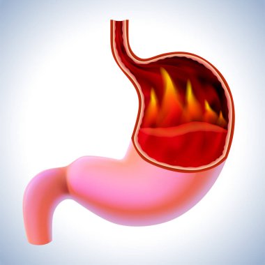 İçinde alevler olan bir midenin 3 boyutlu çizimi, mide iltihabının bir belirtisi olan yanan bir ağrının belirtisidir..