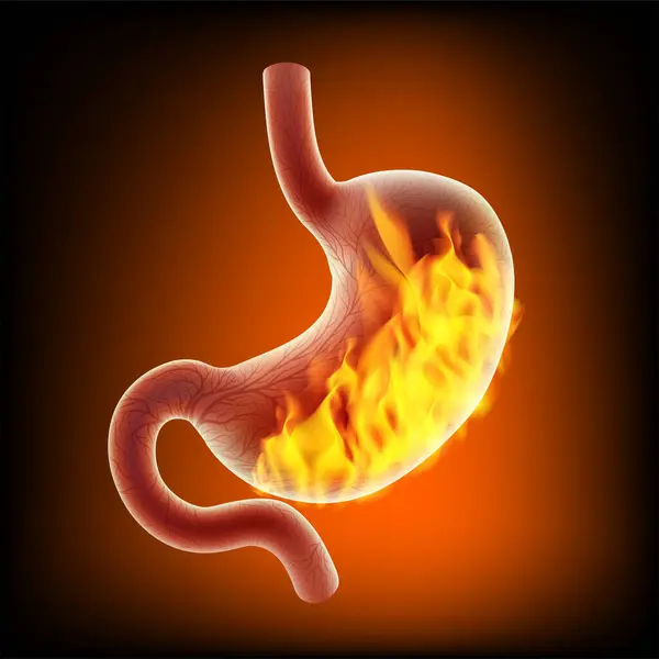 Mide iltihabı olan bir insanla karşılaştırıldığında 3 boyutlu ateş yanığı. Tıp, bilim, eğitim, reklam ve sanayide kullanılır..