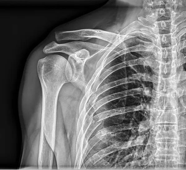 X ray radiograph right shoulder with many broken ribs and shoulder dislocation rib cage