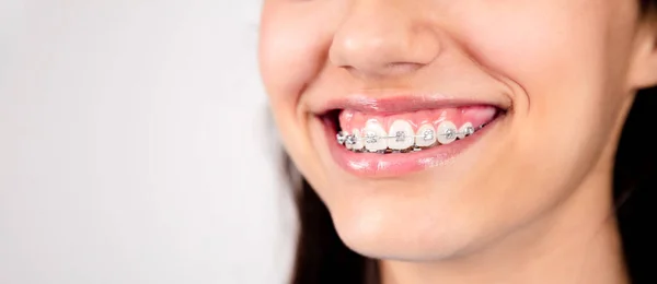 Boca Uma Menina Adolescente Sorrindo Mostrando Metal Ortodontia Branco Fundo — Fotografia de Stock