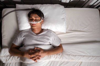 Horlama ve obstrüktif uyku apnesi (OSA) tedavisi için kullanılan CPAP burun maskesiyle yatakta yatan bir adamın üst görünümü. Gece nefesini ve sağlığını iyileştirmek için sessiz ve etkili bir çözüm..