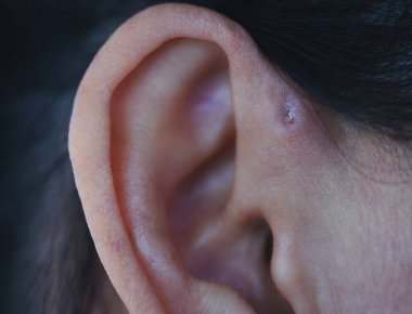 Preauricular sinüs dış kulağın hemen önünde küçük bir çukur gibi görünür, bu sinüsler kötü kokan bir akıntıyı boşaltabilir, ve bu gerçekleştiğinde, kronik enfeksiyona eğilimlidirler..