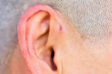 A preauricular sinus appears as a very small pit just in front of the external ear, these sinuses can drain a foul smelling discharge, and when this happens, they are prone to chronic infection. clipart