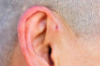 Preauricular sinüs dış kulağın hemen önünde küçük bir çukur gibi görünür, bu sinüsler kötü kokan bir akıntıyı boşaltabilir, ve bu gerçekleştiğinde, kronik enfeksiyona eğilimlidirler..