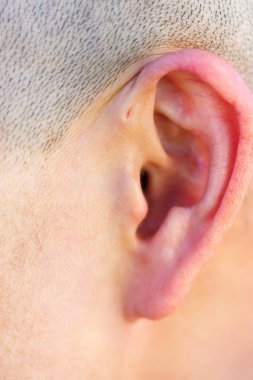 Preauricular sinüs dış kulağın hemen önünde küçük bir çukur gibi görünür, bu sinüsler kötü kokan bir akıntıyı boşaltabilir, ve bu gerçekleştiğinde, kronik enfeksiyona eğilimlidirler..