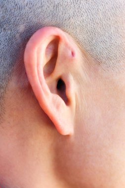 Preauricular sinüs dış kulağın hemen önünde küçük bir çukur gibi görünür, bu sinüsler kötü kokan bir akıntıyı boşaltabilir, ve bu gerçekleştiğinde, kronik enfeksiyona eğilimlidirler..