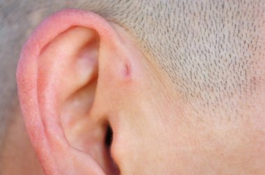 Preauricular sinüs dış kulağın hemen önünde küçük bir çukur gibi görünür, bu sinüsler kötü kokan bir akıntıyı boşaltabilir, ve bu gerçekleştiğinde, kronik enfeksiyona eğilimlidirler..