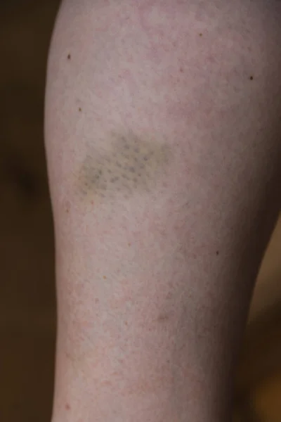 Bacağında Çürük Çürük Hematom Yaralanma — Stok fotoğraf