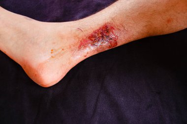 Bacağında yara olan bir adamın dizi.