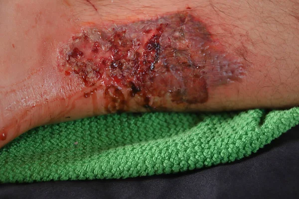 包扎一个人膝盖上的伤口后的伤口 免版税图库图片