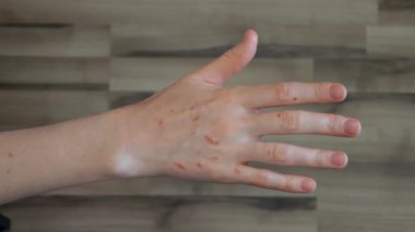 Yaralı elin yakın çekim görüntüsü. Bitkilerden kaynaklanan çizikler ya da yanıklarla elini gösteren genç bir kadın. Sorunlu cilt, yanık ve çiziklerin tedavisi.