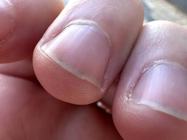 Sokak manzarasında kirli tırnakları olan iki bükük erkek parmak. Yüksek kalite fotoğraf