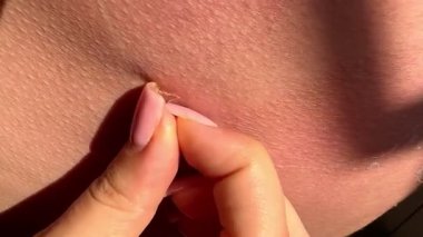 Güneş yanığı üstüne deri soyma, yanmış kırmızı insan derisi, yanıklar, yeni deri. Yüksek 4k kalite