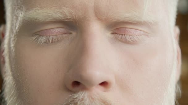 Yakışıklı Albino Erkek Gözlerini Kapat Çeşitlilik Kavramı Eşitlik Farklı Irktan — Stok video