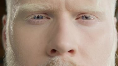 Gülümseyen rahat adam kameraya bakıyor. Renkli saçlı, soluk tenli bir erkek model. Çeşitlilik kavramı, eşitlik ve farklı ırktan ve milletten insanlar. Yakışıklı albino erkek gözlerini kaybet.