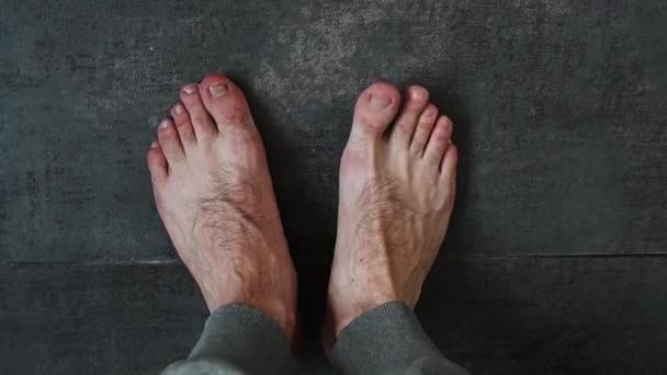 男人的脚有指甲问题 皮肤病学 从上往下看 — 图库视频影像