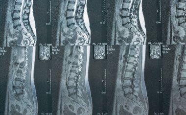 İnsan omurgasının bilgisayarlı tomografi taraması