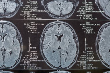 Beynin manyetik rezonans görüntülemesi veya MRI görüntülemesi