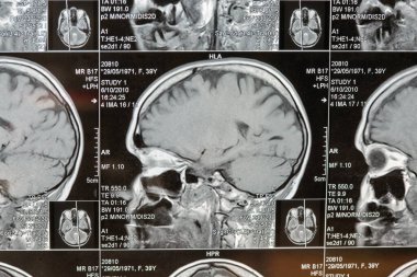 Beynin manyetik rezonans görüntülemesi veya MRI görüntülemesi