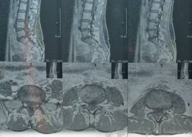 İnsan omurgasının bilgisayarlı tomografi taraması
