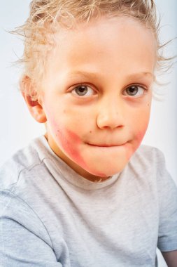 Close-up portrait of a blond child with flushed red cheeks and chin, showing signs of an allergic reaction to food or a skin condition, highlighting discomfort and irritation clipart