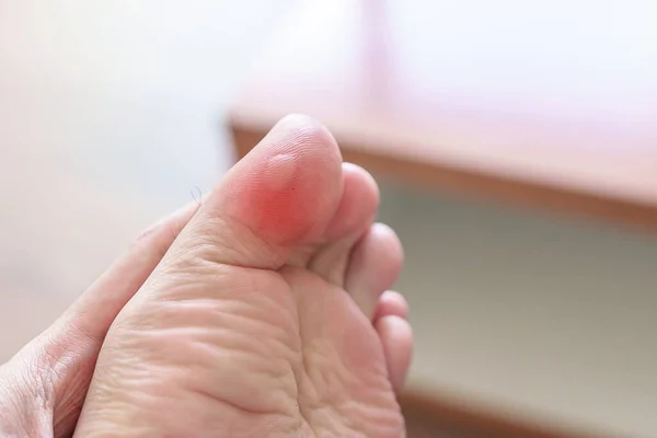 man having bunion toes or blister due to wearing narrow shoes and waking or running longtime, barefoot pain due to Plantar fasciitis. Health and medical concept