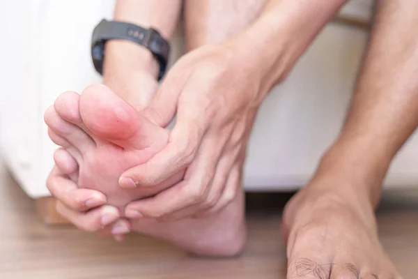 man having bunion toes or blister due to wearing narrow shoes and waking or running longtime, barefoot pain due to Plantar fasciitis. Health and medical concept