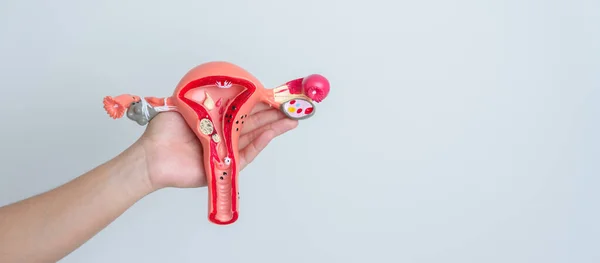 Woman Holding Uterus Ovaries Model Ovarian Cervical Cancer Cervix Disorder — Fotografia de Stock