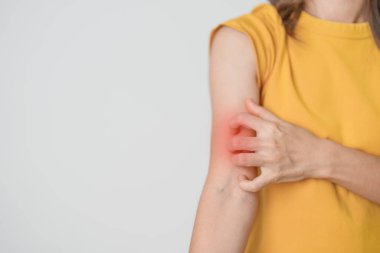Kaşınan ve kaşınan bir kadın. Böcek ısırığına karşı hassas deri alerjisi, yemek, uyuşturucu dermatiti. Dermatoloji, cüzzam günü, sistemik lupus eritematoz, alerji semptomları ve isilik.