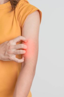 Kaşınan ve kaşınan bir kadın. Böcek ısırığına karşı hassas deri alerjisi, yemek, uyuşturucu dermatiti. Dermatoloji, cüzzam günü, sistemik lupus eritematoz, alerji semptomları ve isilik.